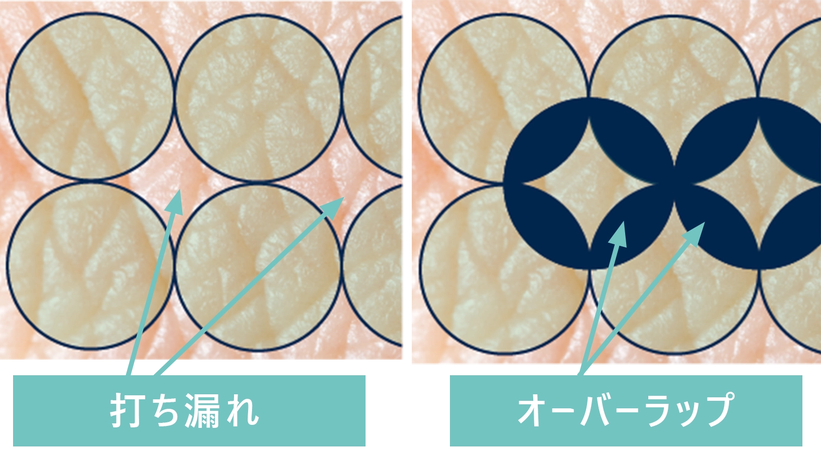 ラウンドスポット照射のイメージ画像