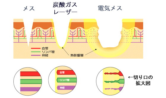 炭酸ガスレーザーによる治療のイメージ画像